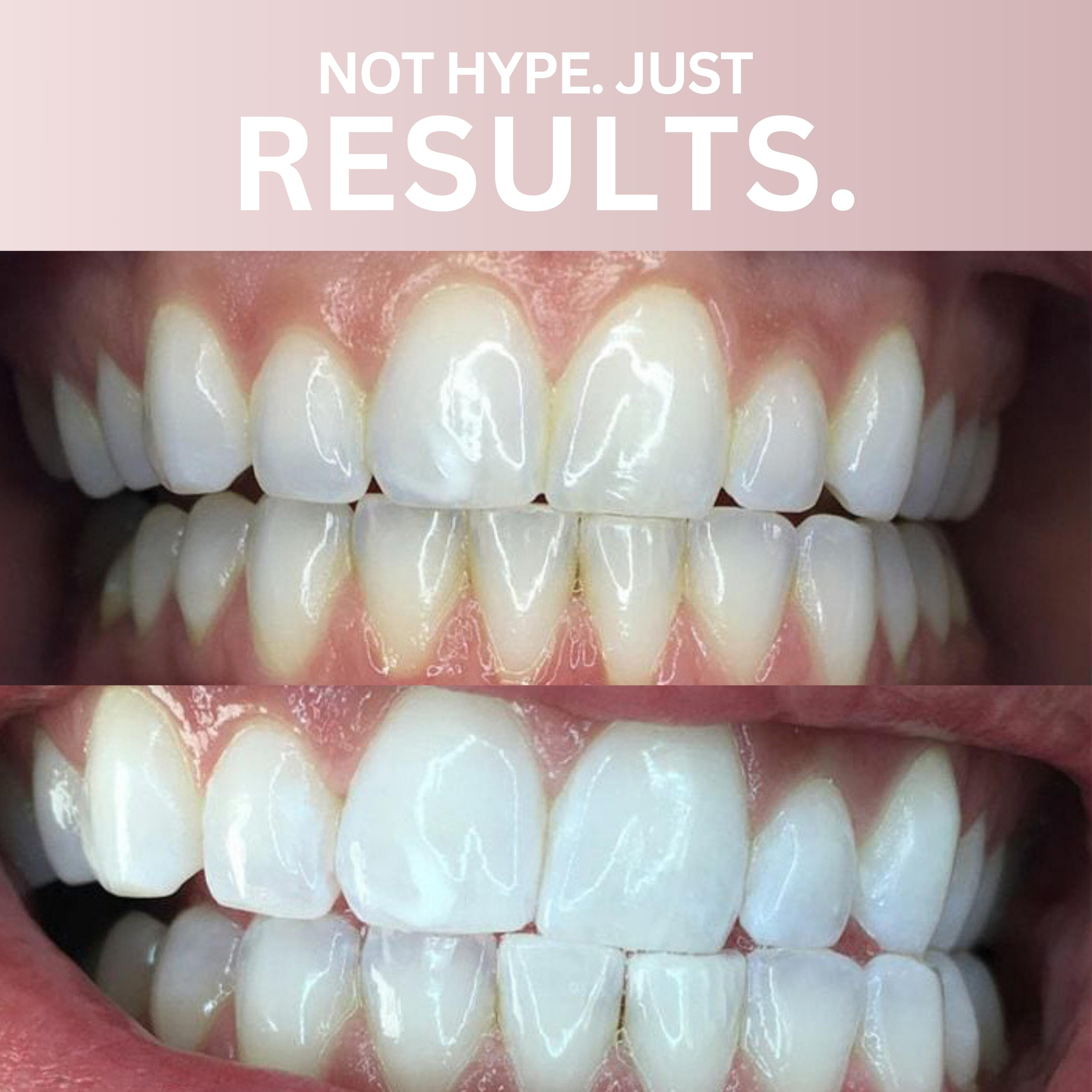 Bandes de blanchiment des dents